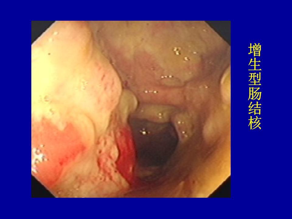 肠,腹膜结核高清内镜病例涂片