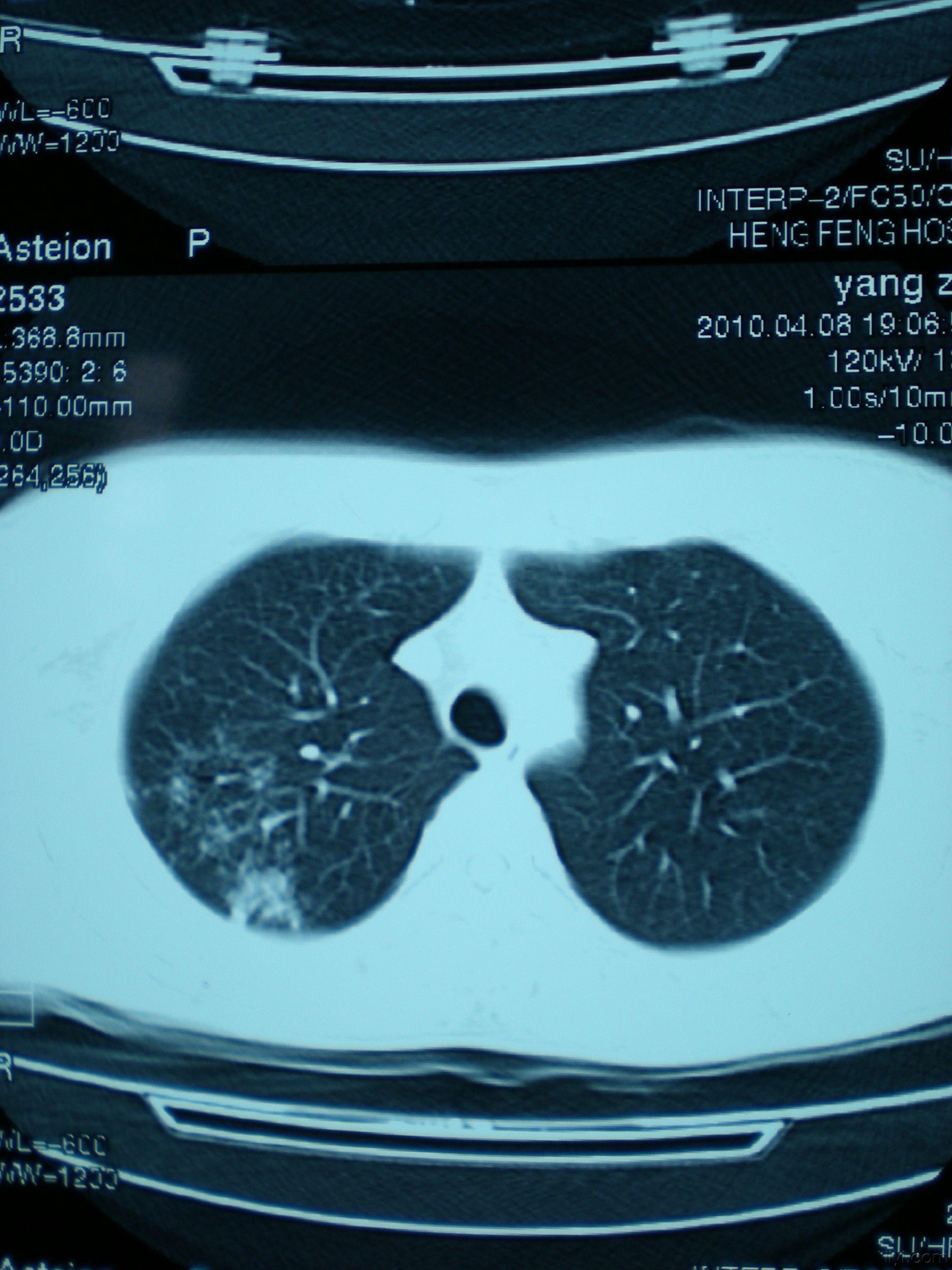 crct显示有肺结核但是没症状怎么办