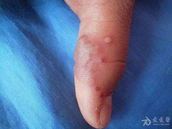 典型病例分享:手指单纯疱疹