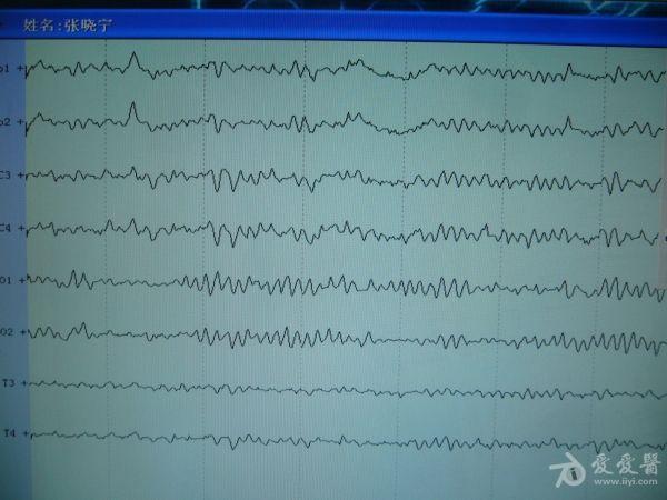 【请教】 这个该怎么诊断啊,做的24小时视频脑电.谢谢大家啦.