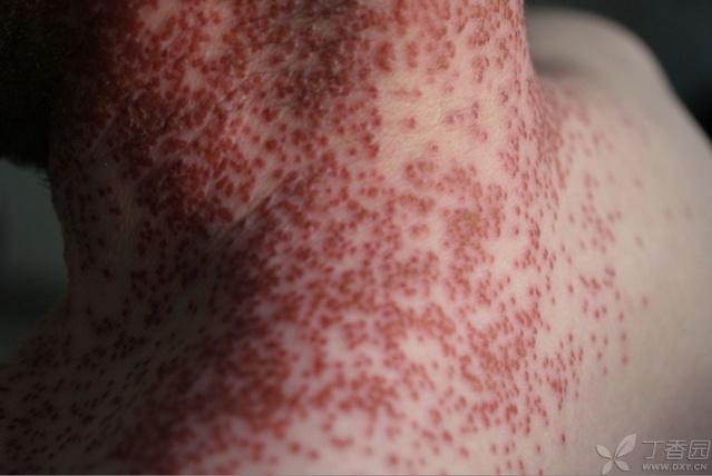痛性皮疹:皮疹首先发于口周,后渐蔓延至面部,颈部和肩
