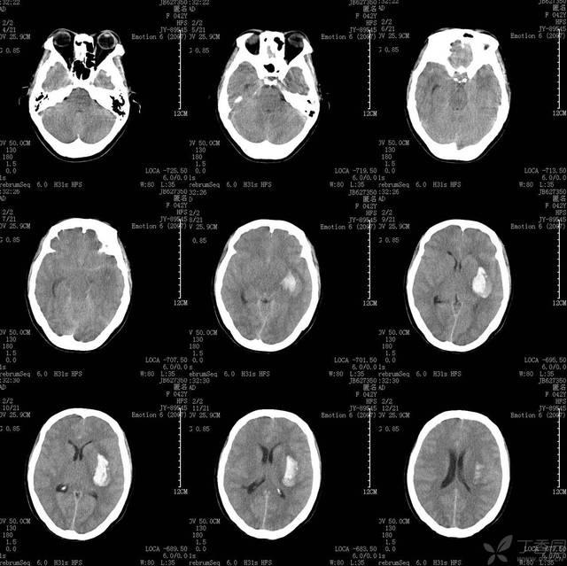 外囊出血10余毫升,突发脑疝一例 病例中心(诊疗