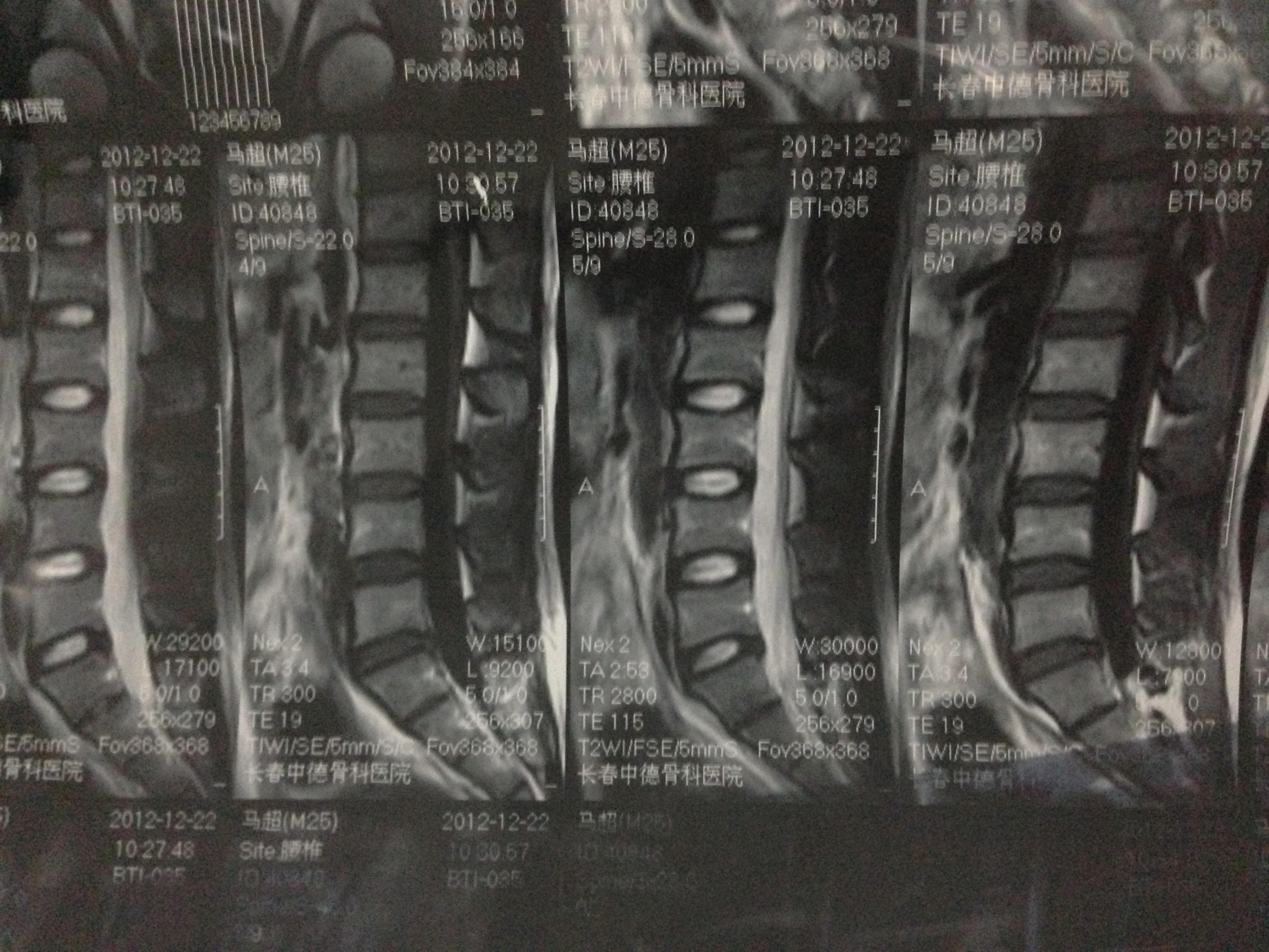 是骨节错位还是腰间盘突出