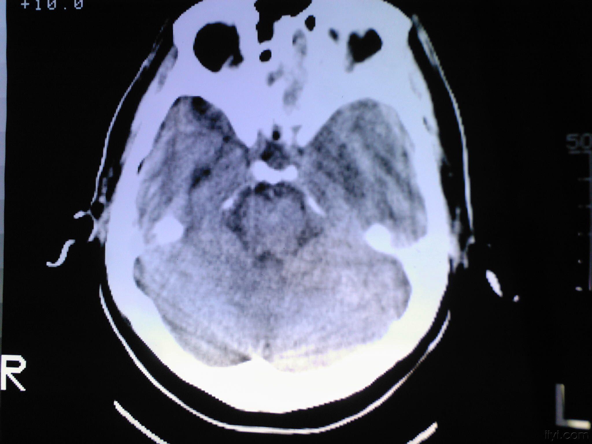 高尚病例：PET-CT/MRI 多模态检查实现「一站式」诊断-医院汇-丁香园