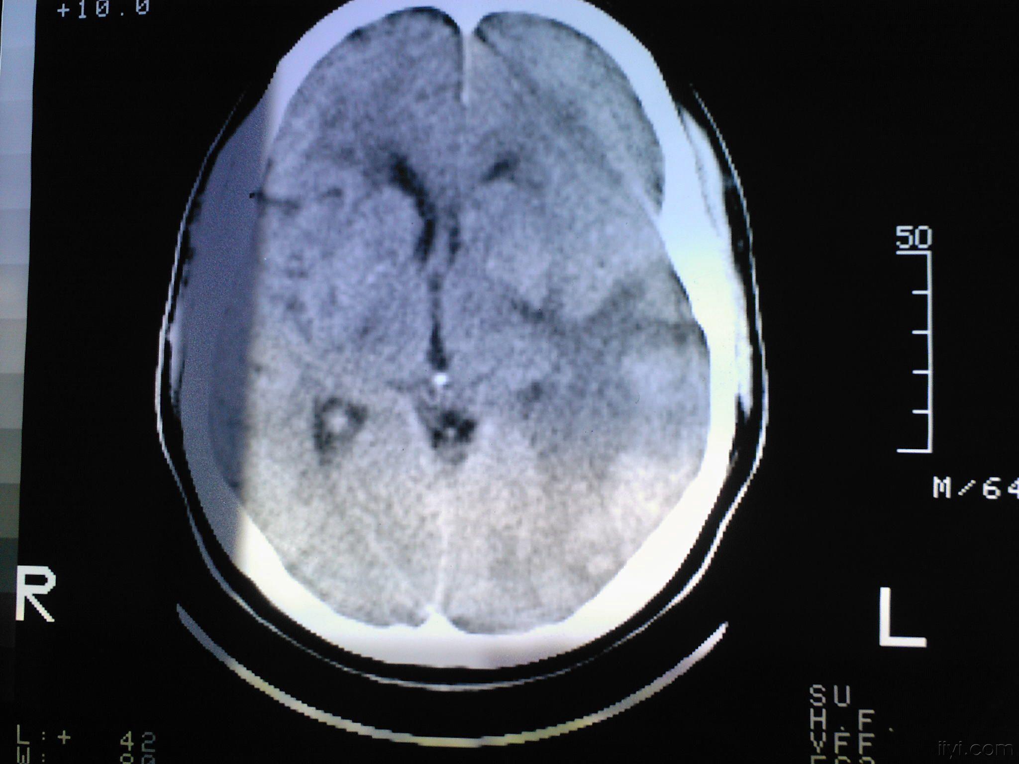 医疗脑出血图片大全-医疗脑出血高清图片下载-觅知网