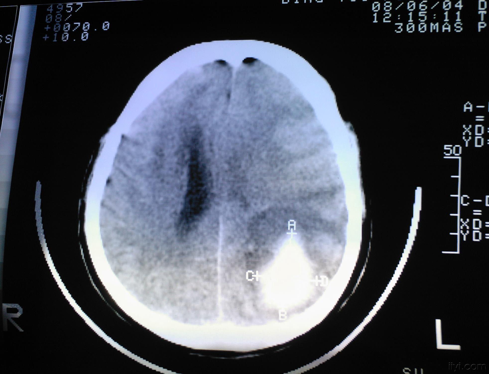 典型脑出血病例分享（含CT及MRI）_疾病分享_快速问医生
