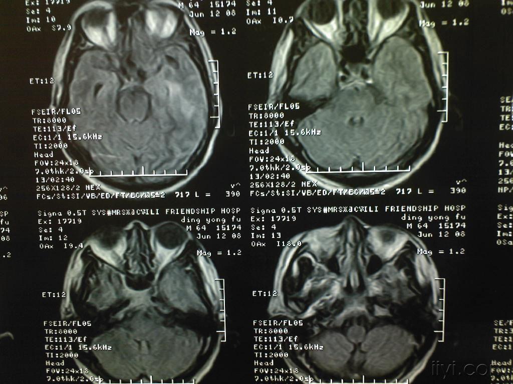 头颅 MR、CT 临床实用「影像征」（三） - 脑医汇 - 神外资讯 - 神介资讯