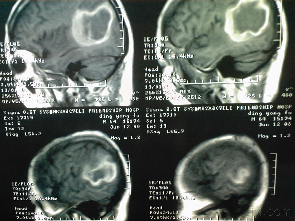 脑外伤后行头CT无意中发现脑肿瘤_疾病分享_快速问医生