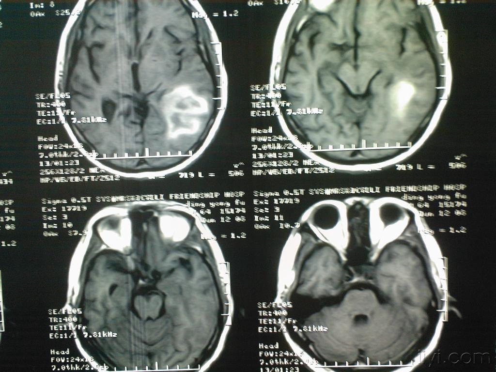 脑CTA或脑CT血管造影MIP技术轴向视图用于检测脑动脉瘤。照片摄影图片_ID:401305269-Veer图库
