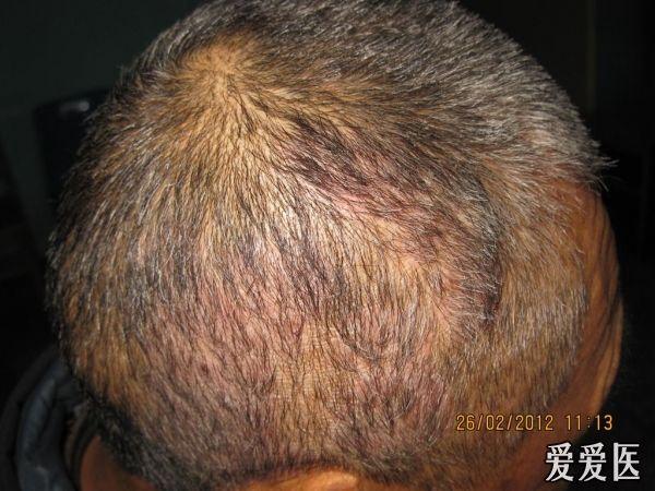 典型病例银屑病束状发