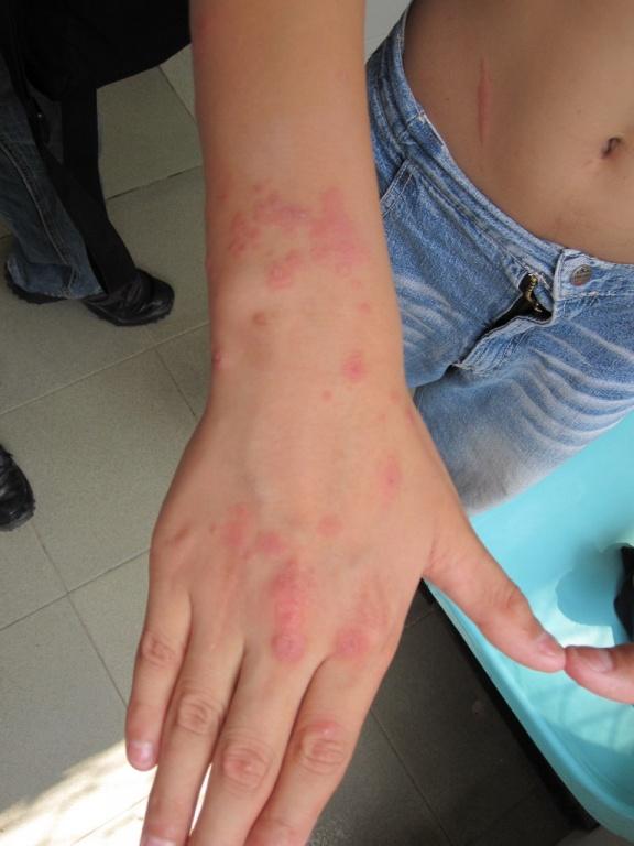 单纯疱疹导致的复发性多形红斑病例一张