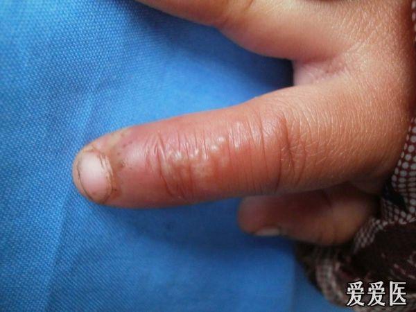典型病例手指单纯疱疹