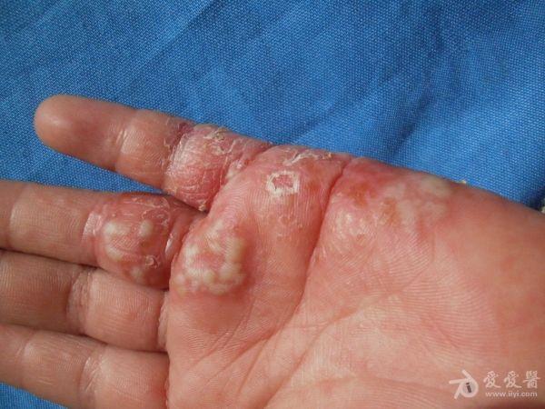 分享病例:小儿手部单纯疱疹.