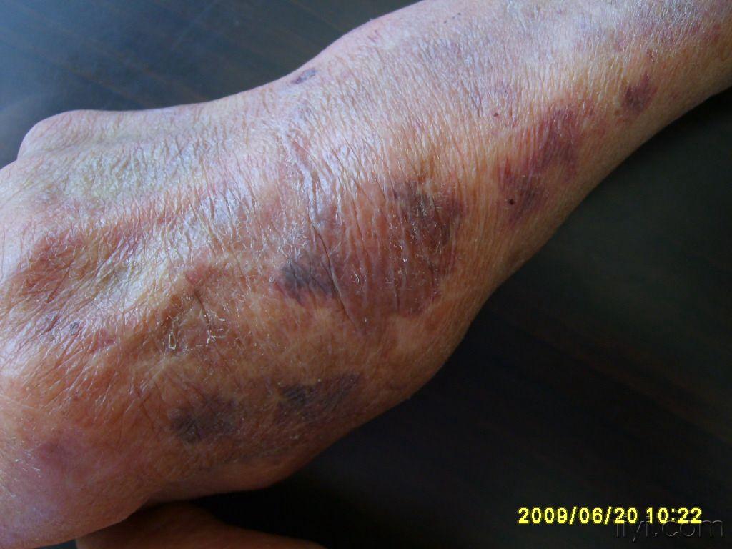 典型病例:老年性紫癜