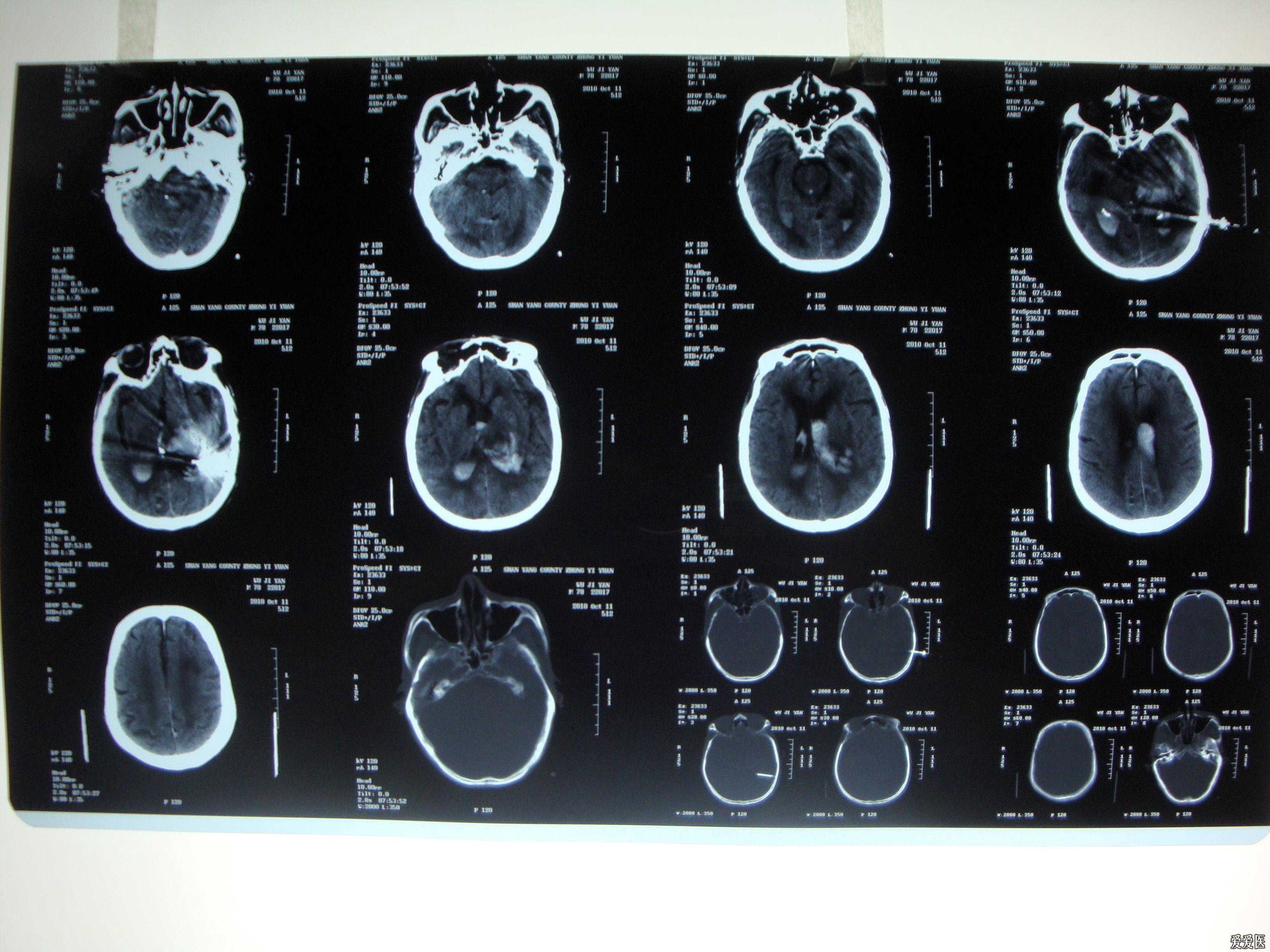 基于颅脑MRI/MRA影像学的烟雾综合征急性脑梗死模式与血管狭窄特征的相关性研究 - 磁共振成像