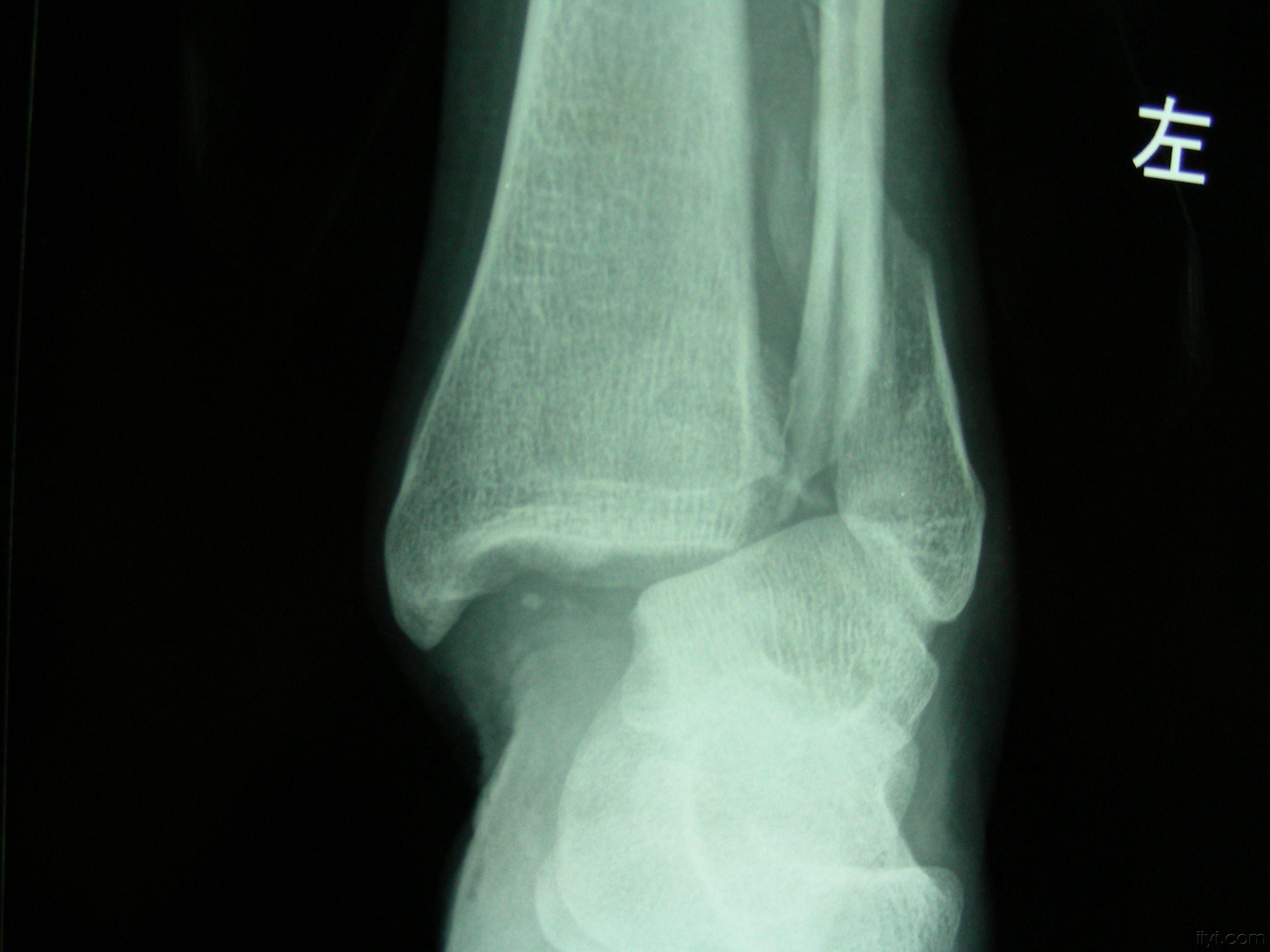 左内外后踝骨折、左踝半脱位；左跟骨及足舟骨骨折。