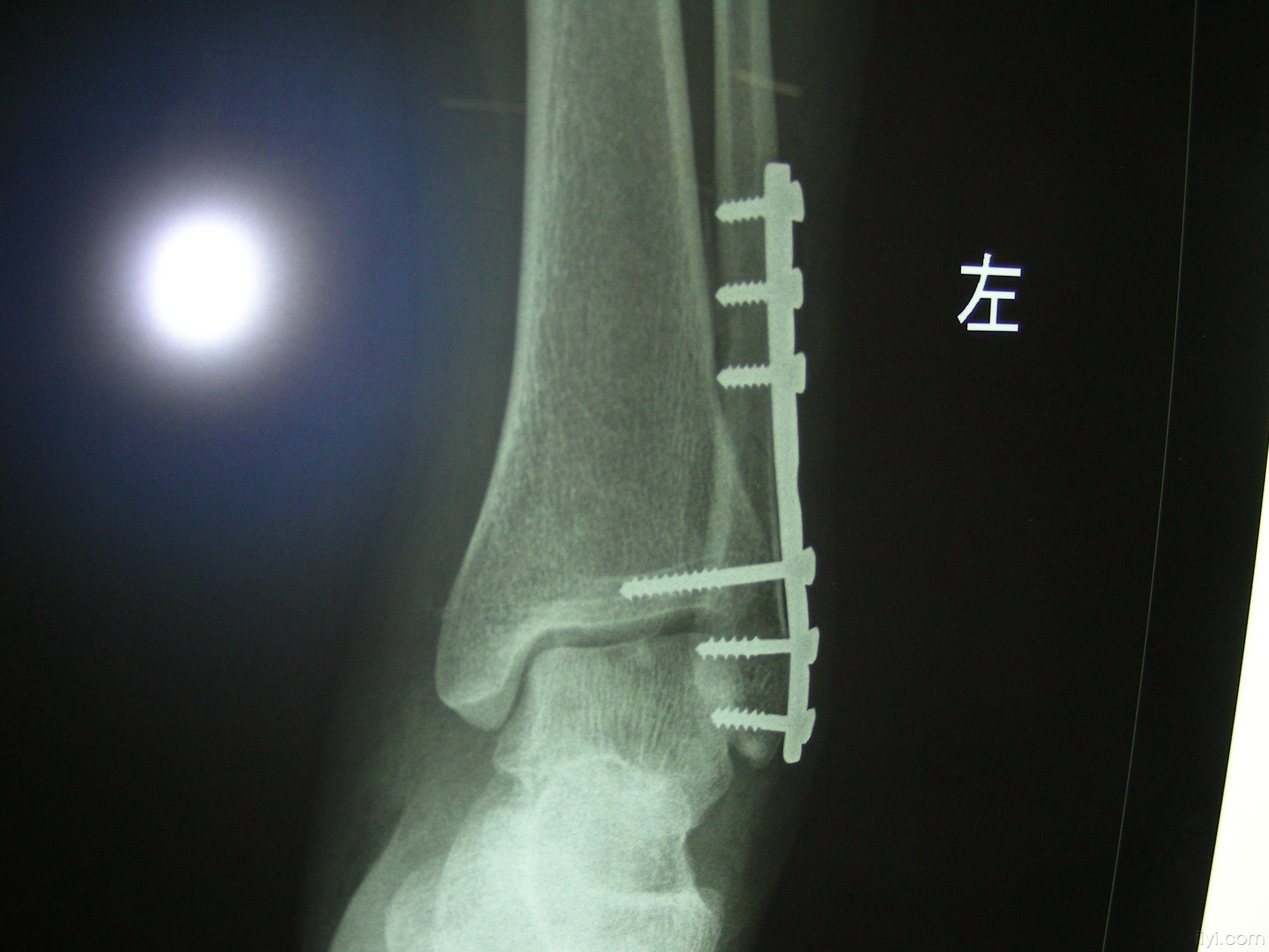 左外后踝骨折（切复内固定术）