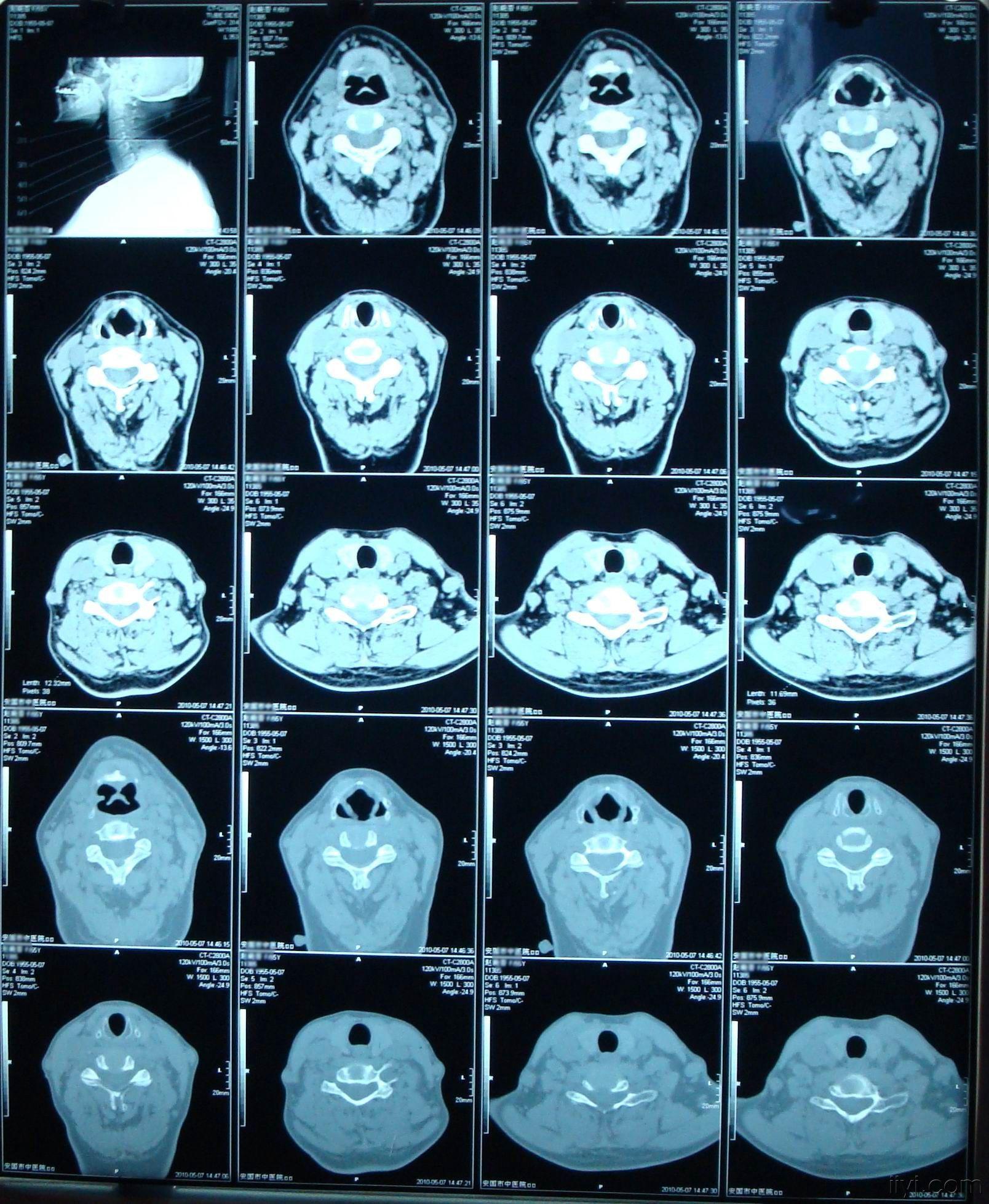 第3、4颈椎体阻滞椎CT病例图片影像诊断分析！-MedSci.cn