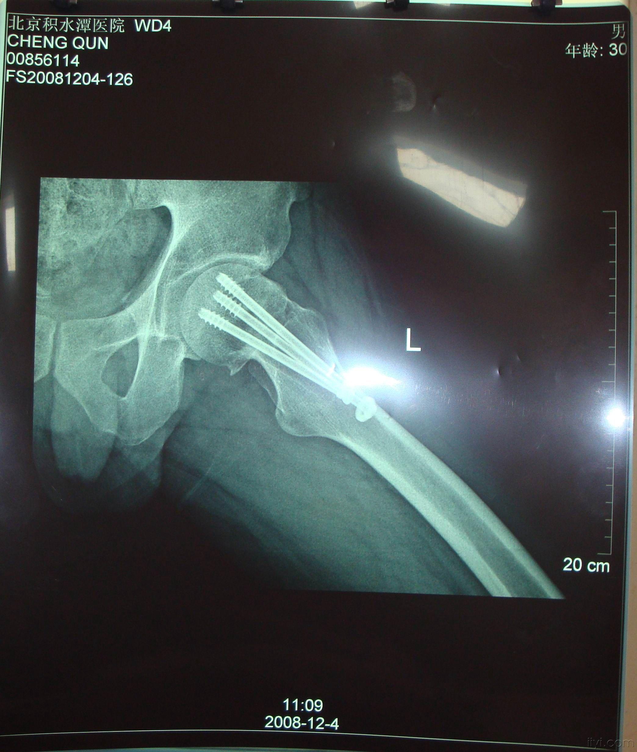 左侧股骨转子间骨折（AO分型 A2.1）-病例讨论-唯医,allinmd