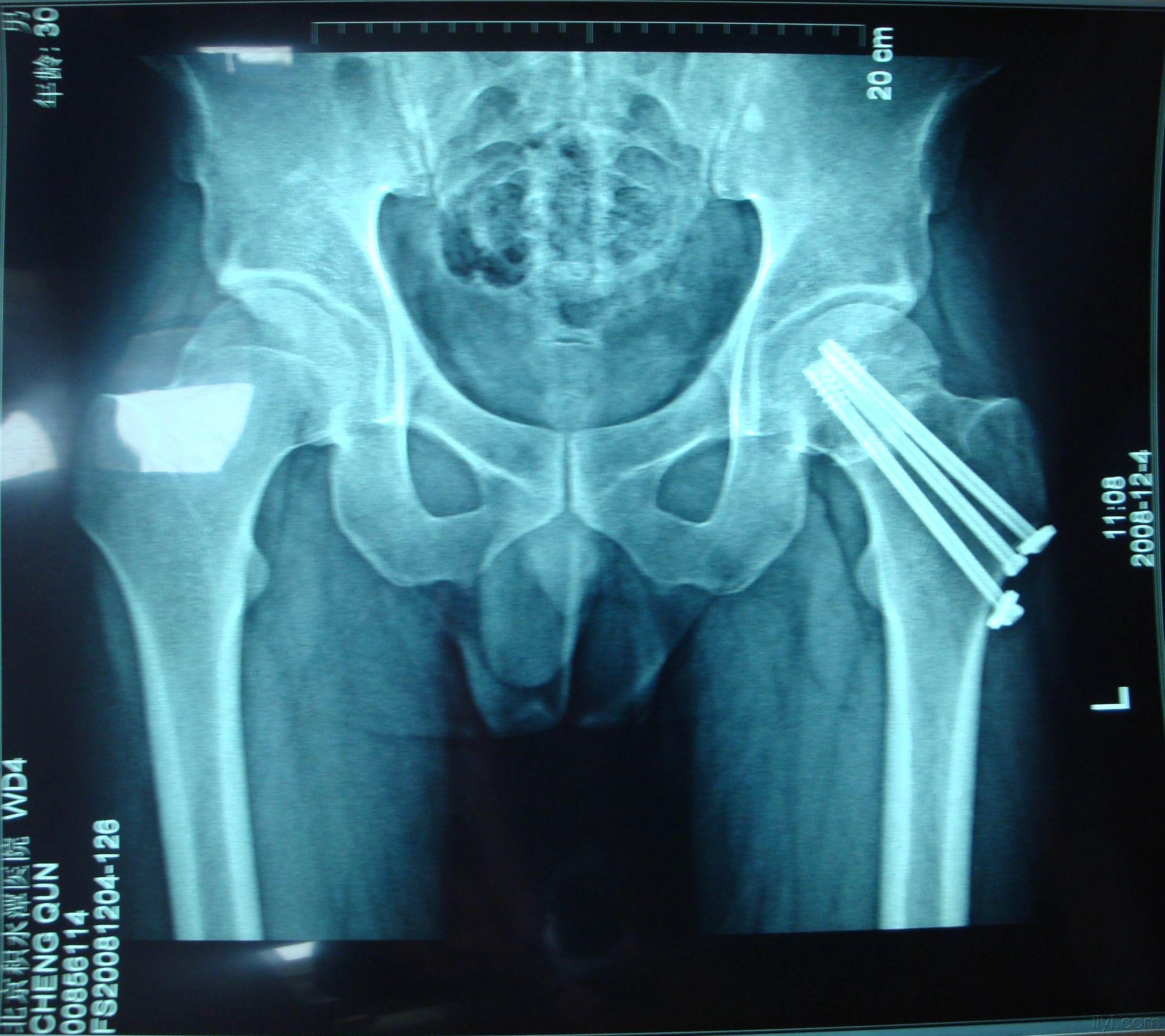 2.2 股骨粗隆间骨折-骨伤科创伤病例-医学