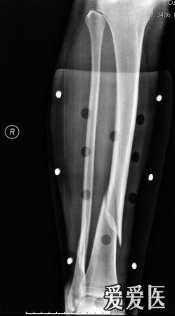 小腿中下段螺旋形骨折髓内针固定,锁钉安装后发现有旋转移位