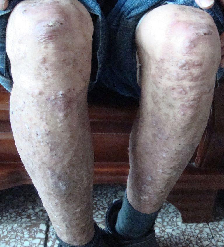 【一般资料】 患者男,40岁 【病史】 面部及手足四肢伸侧皮疹10年余