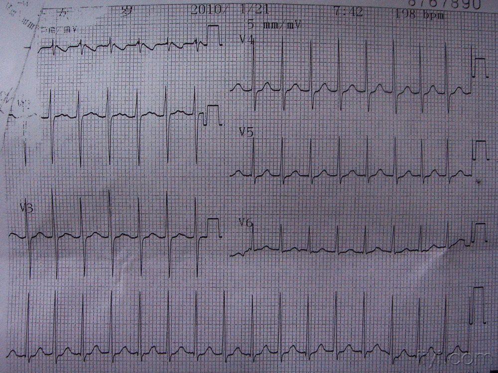 室上性心动过速病例一例!