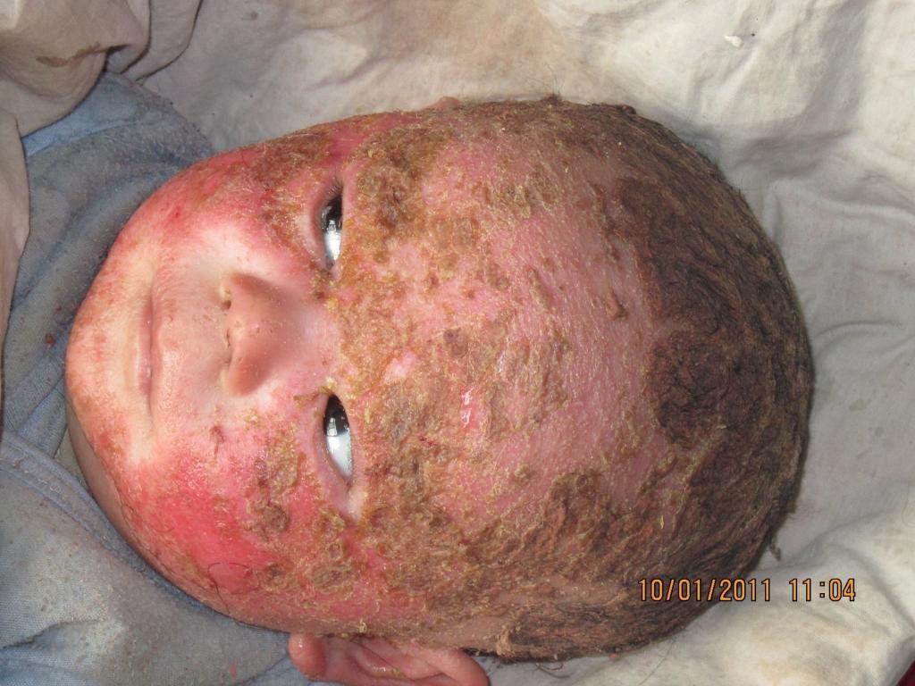 婴儿头面部湿疹详细病例一例