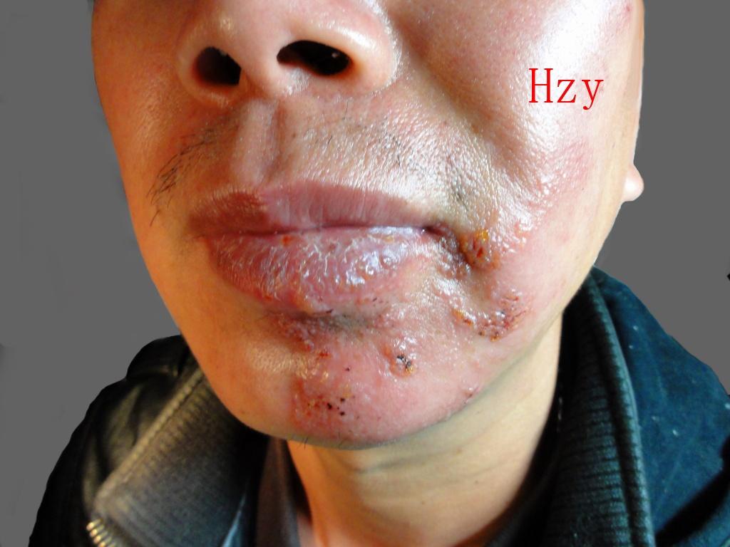 疾病 带状疱疹 > 左侧口腔及脸部皮损五天 附件:点击查看大图