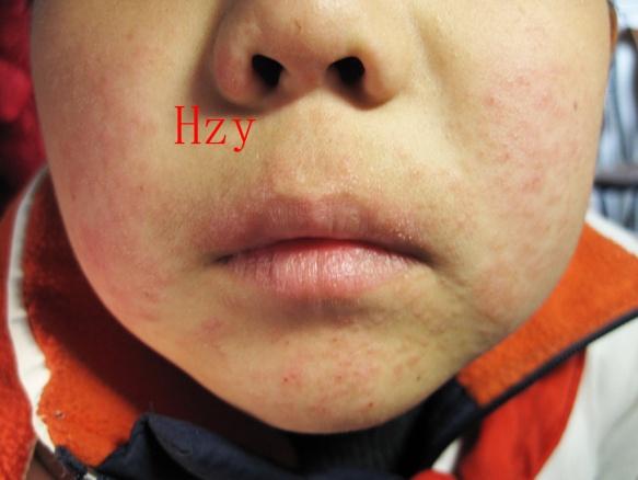 疾病 持续性肢皮炎 > 近来小儿脸部患这种病的很多  附件:点击查看