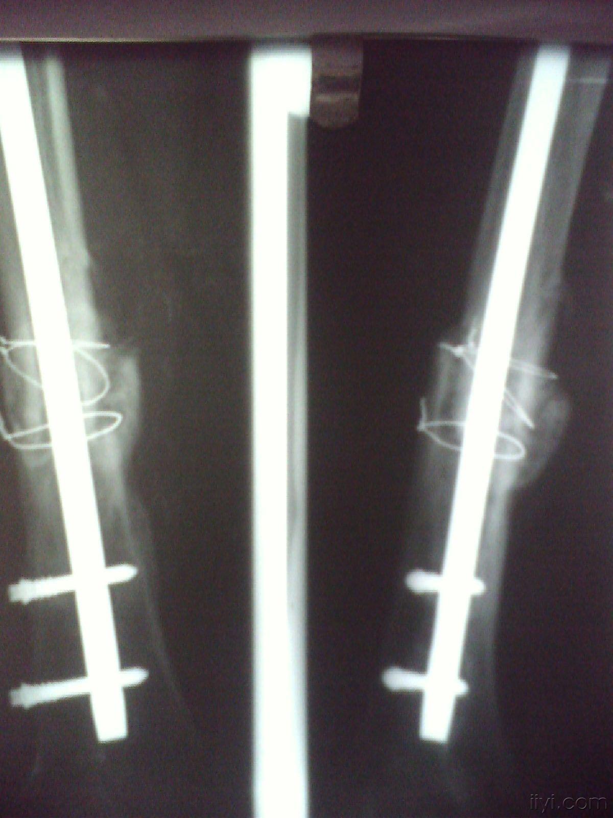 肱骨骨折桡神经损伤康复及取钢板经历分享 - 知乎