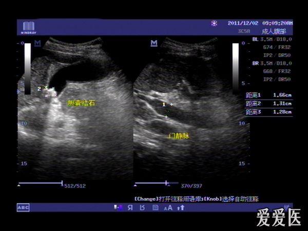 胆总管结石难逃超声法眼