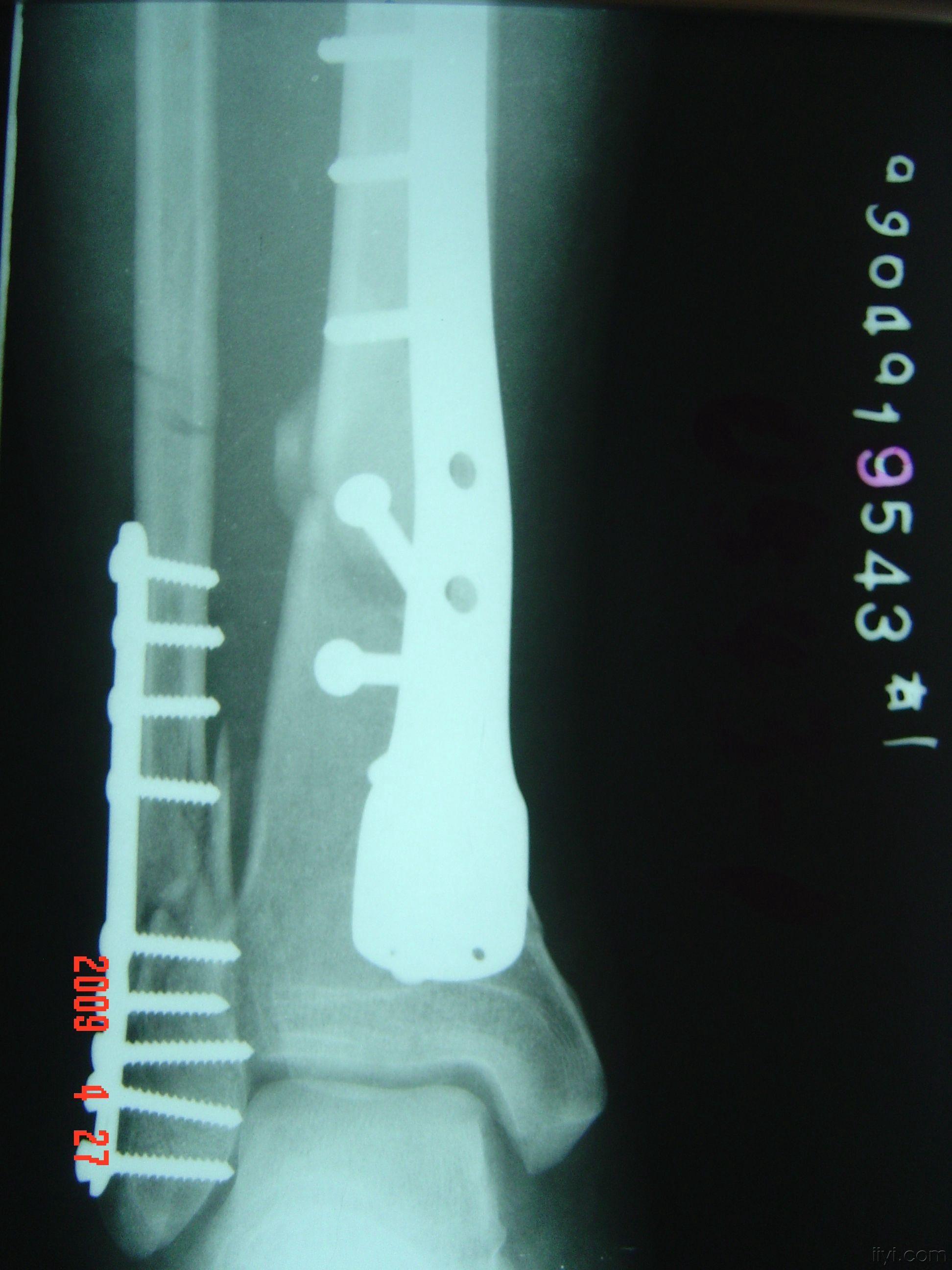 图4-106 小腿骨间膜(前面观)-外科学-医学