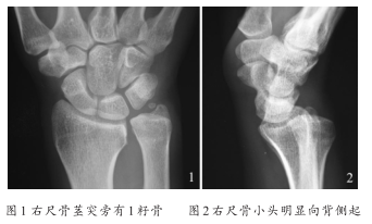 腕关节尺骨茎突旁籽骨 病例中心(诊疗助手 爱爱医医学网