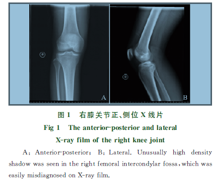 膝关节后交叉韧带止点周围骨软骨瘤1例