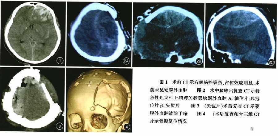 术中恶性脑膨出一例