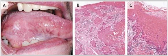 舌鳞状细胞癌一例