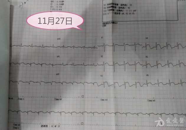 stt弓背向上抬高肌钙蛋白阳性心肌梗死