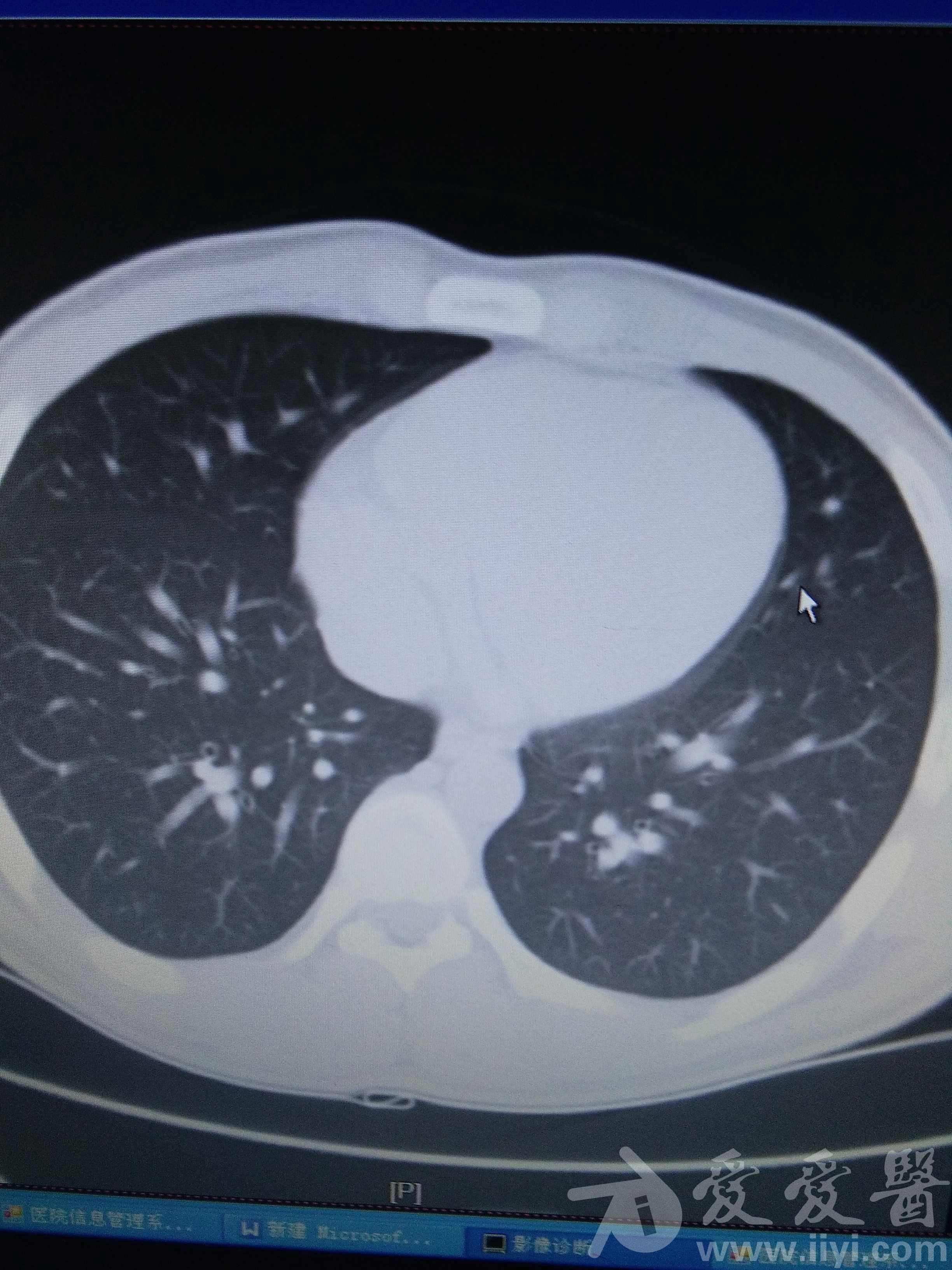 支气管炎一例