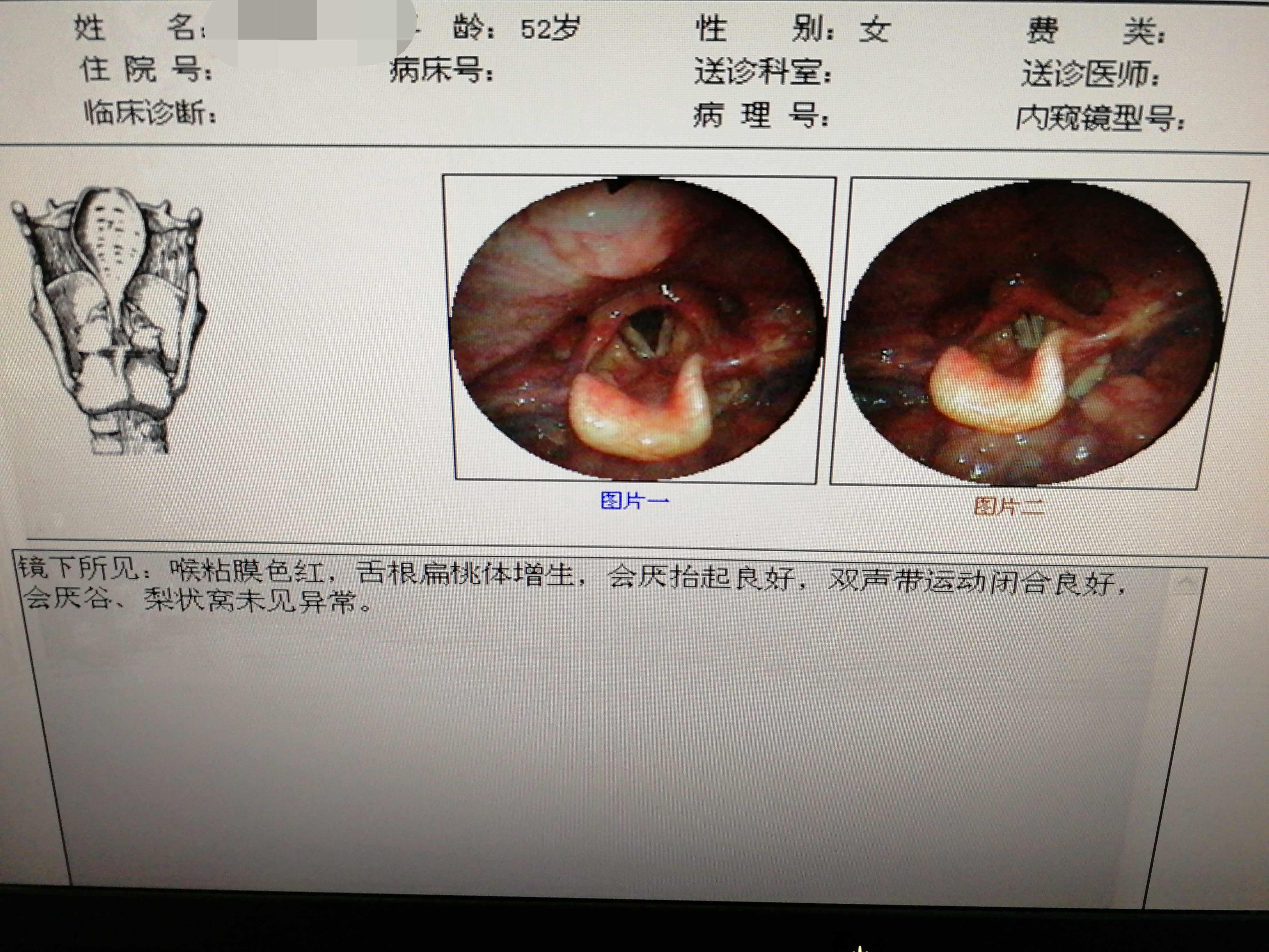 慢性咽炎一例