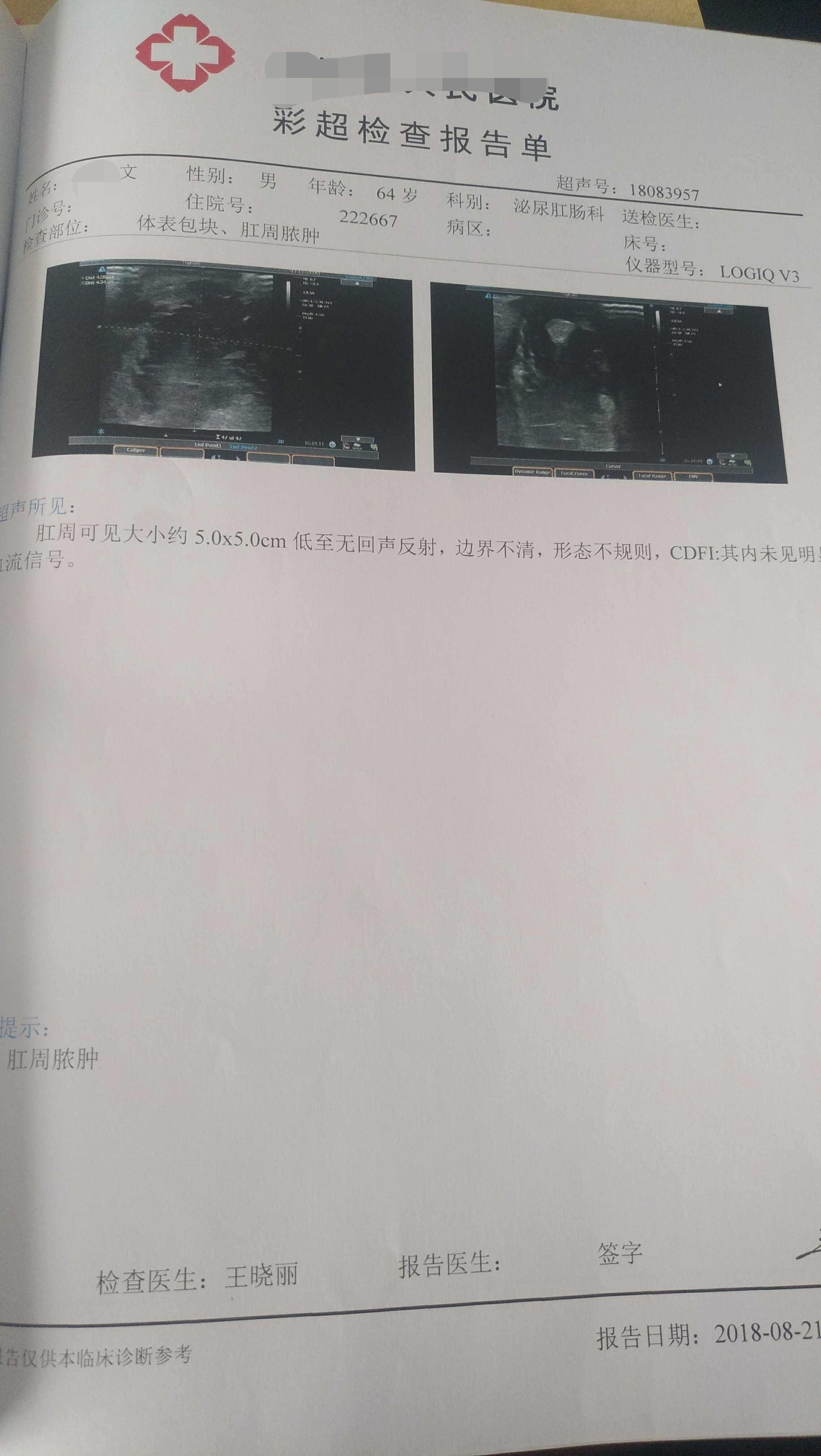 肛瘘,肛周脓肿1例