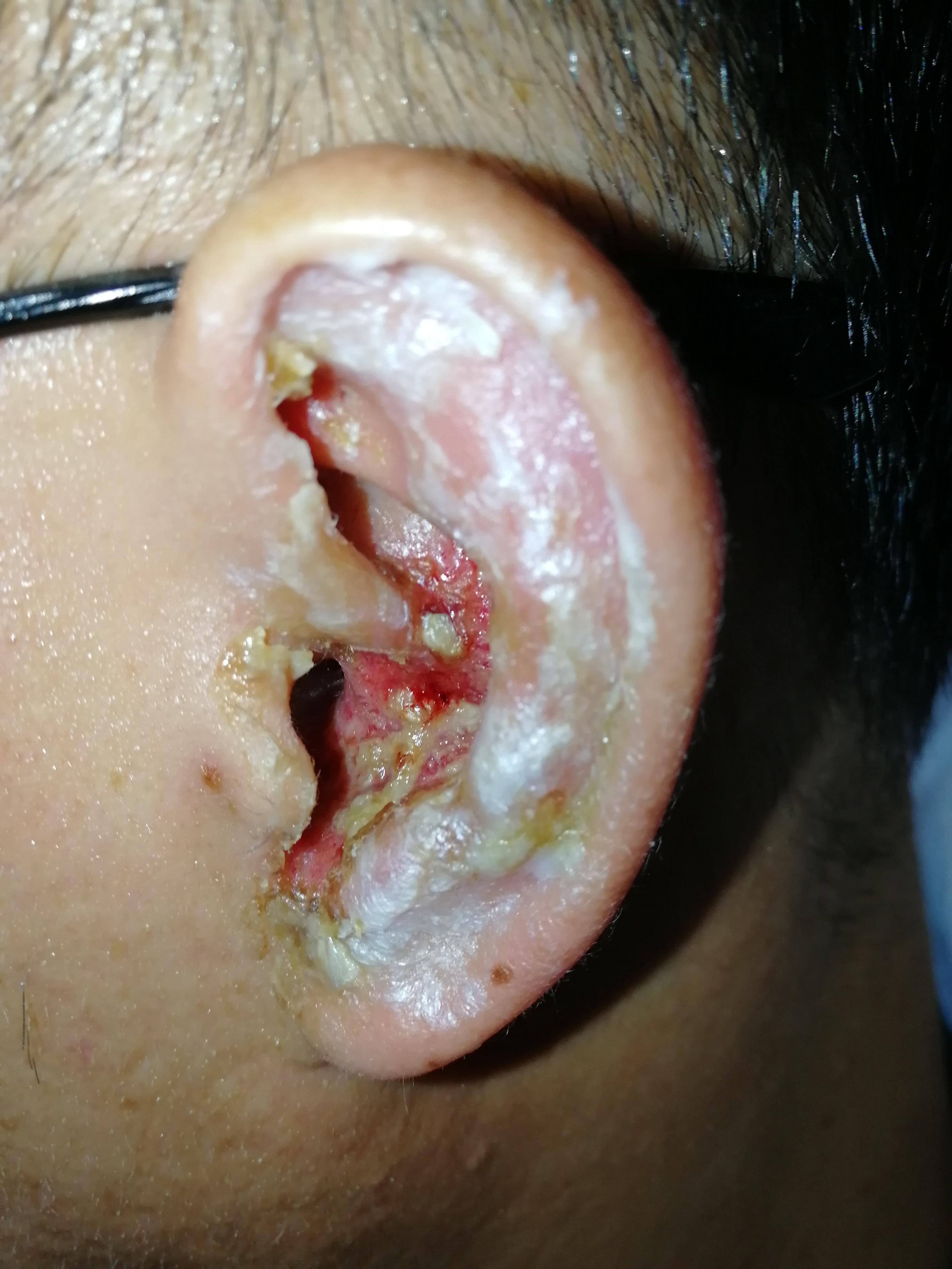 耳带状疱疹一例