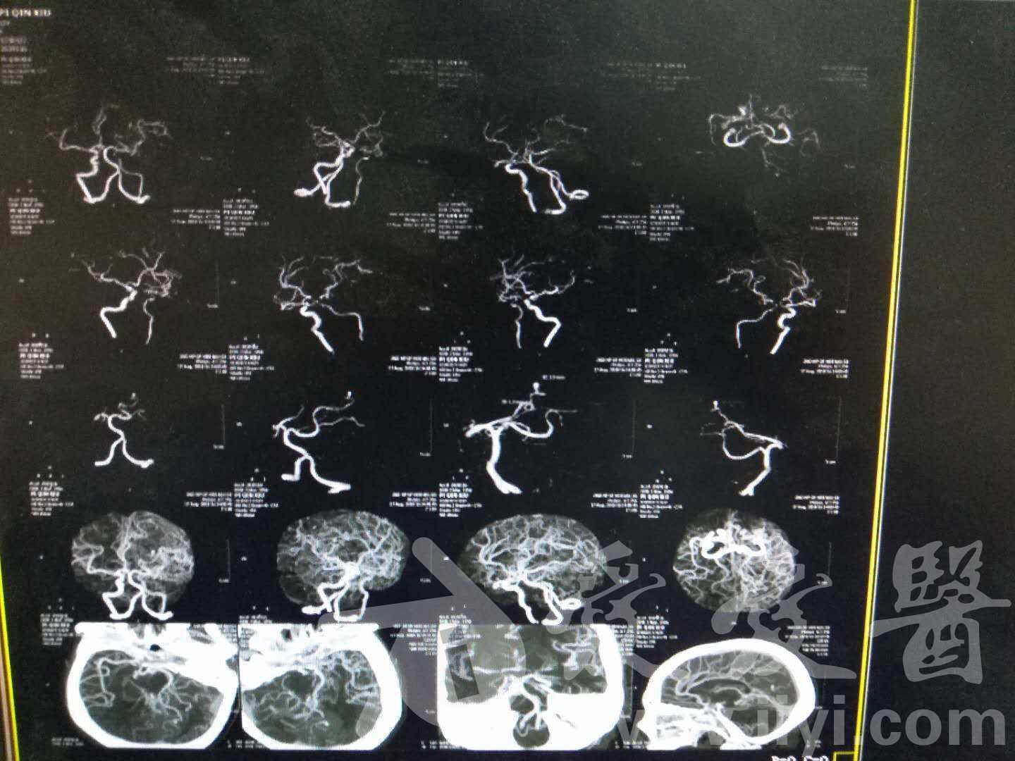 蛛网膜下腔出血一例