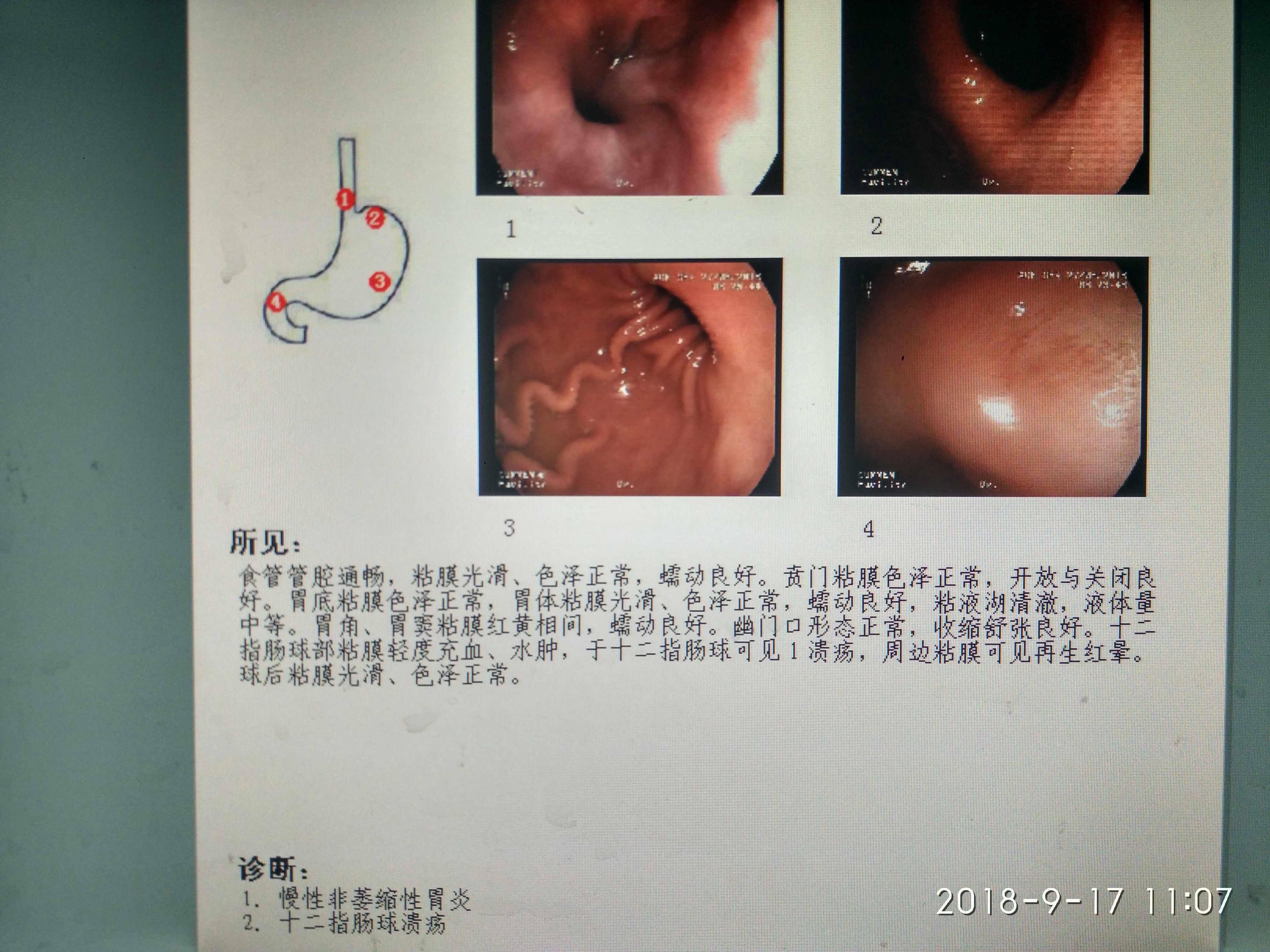 十二指肠溃疡间断腹痛一例