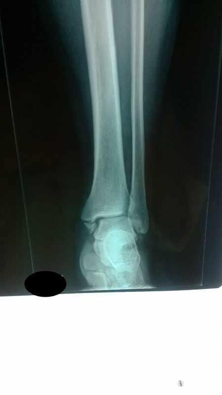 左内踝骨折行左内踝骨折切开复位内固定术一例