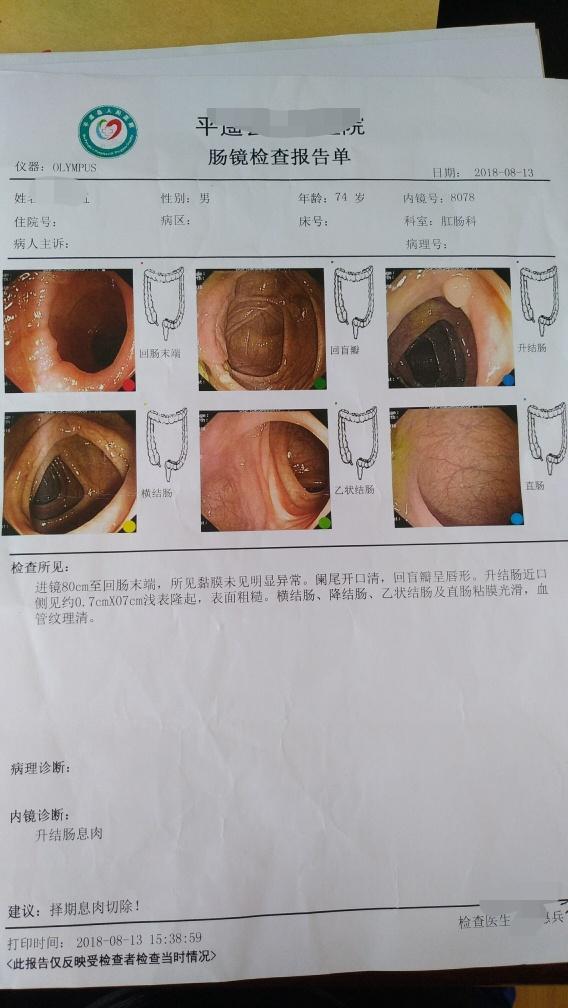 间断性左下腹部憋胀结肠息肉一例