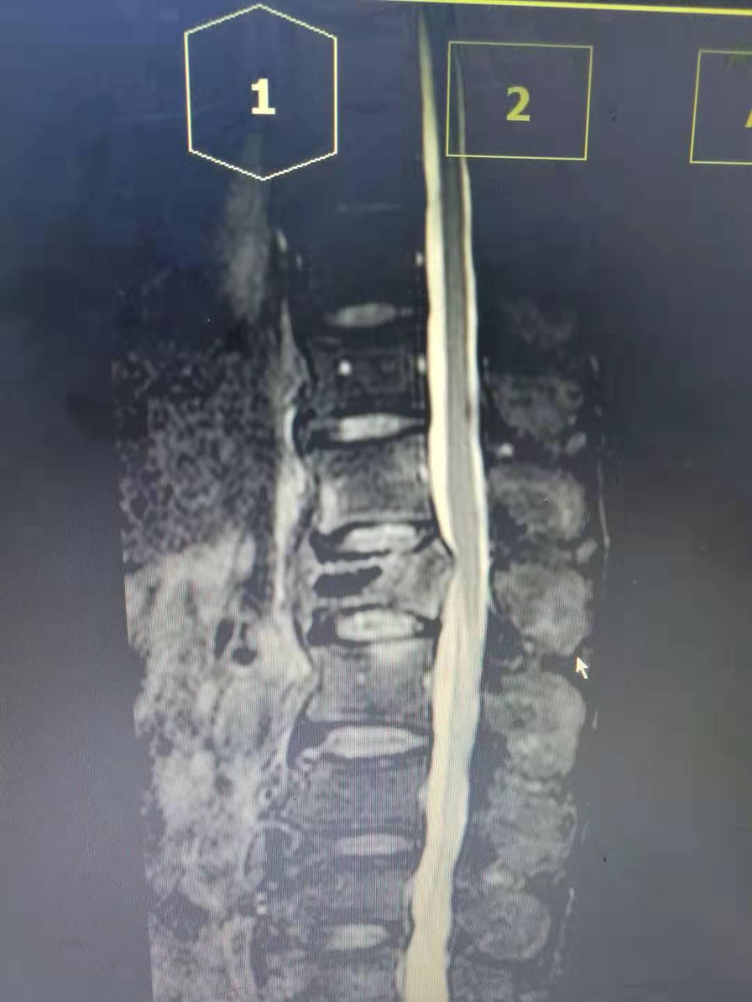 pvp治疗腰1椎体压缩性骨折