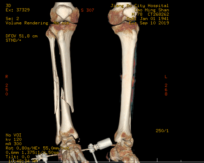 右侧胫腓骨开放性骨折外固定支架外固定加克氏针内固定治疗分享