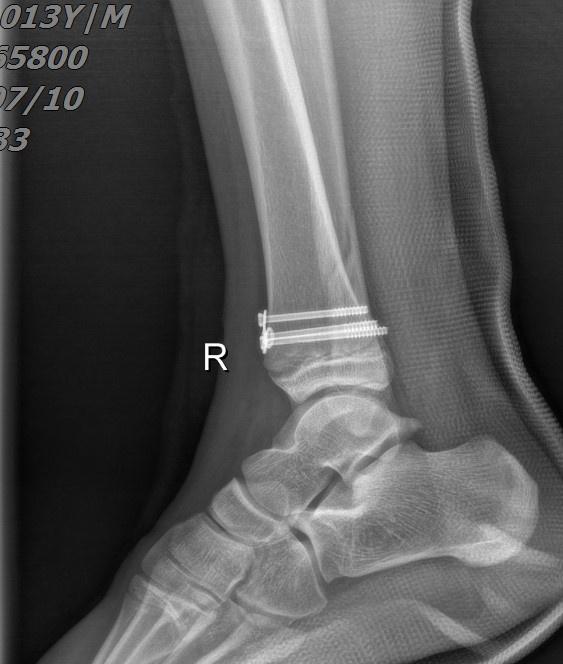 踝关节骨骺损伤的处理