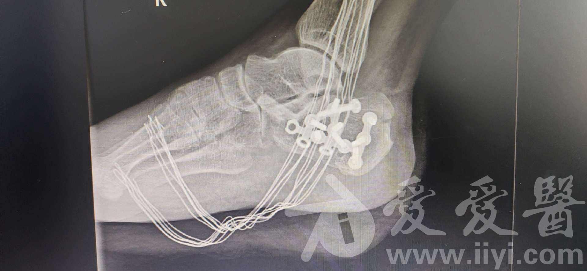一例右足跟骨骨折切开复位内固定术治疗分享
